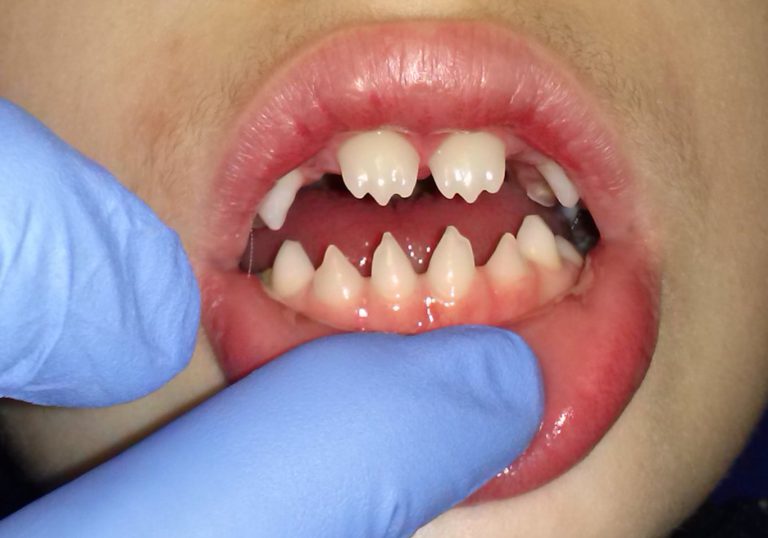 Dientes de Hutchinson